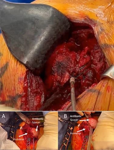 BioEnthesis™: Surgical technique video preview — Subscapularis Repair With Biphasic Allograft, by Dr. Alan Reynolds
