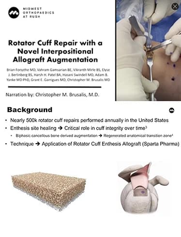 BioEnthesis™: Surgical technique video preview — Rotator Cuff Repair With Interpositional Allograft, by Dr. Brian Forsythe