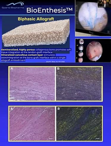 BioEnthesis™: Conference talk preview — Rotator Cuff Patches and Augmentation, by Dr. Shariff Bishai